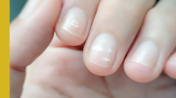 белые пятна на ногтях, болезни по ногтям