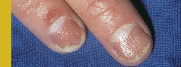 углубления на ногтях, болезни по ногтям