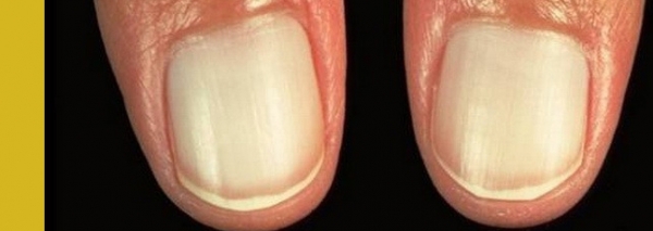 белесые ногти, бледные ногти, болезни по ногтям