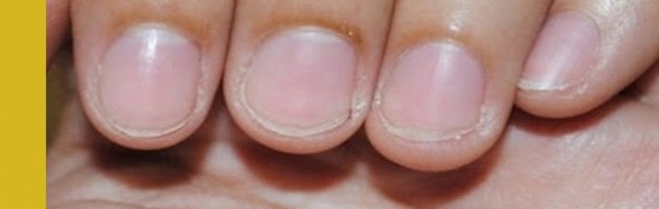 лунки на ногтях, болезни по ногтям