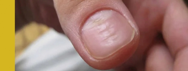 горизонтальные линии на ногтях, болезни по ногтям