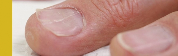 вогнутые ногти, болезни по ногтям, здоровье по ногтям, признаки заболеваний по ногтям